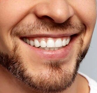 روش‌های سفید‌کردن دندان 